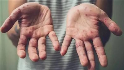 فيروس جدري القرود لا يشكل تهديدًا كبيرًا لجائحة بفضل اللقاحات والعلاجات