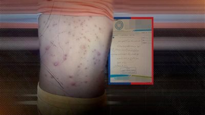 أولياء أمور بنت الصديق بالشيخ زايد يستغيثون من إصابة التلاميذ بمرض معدي